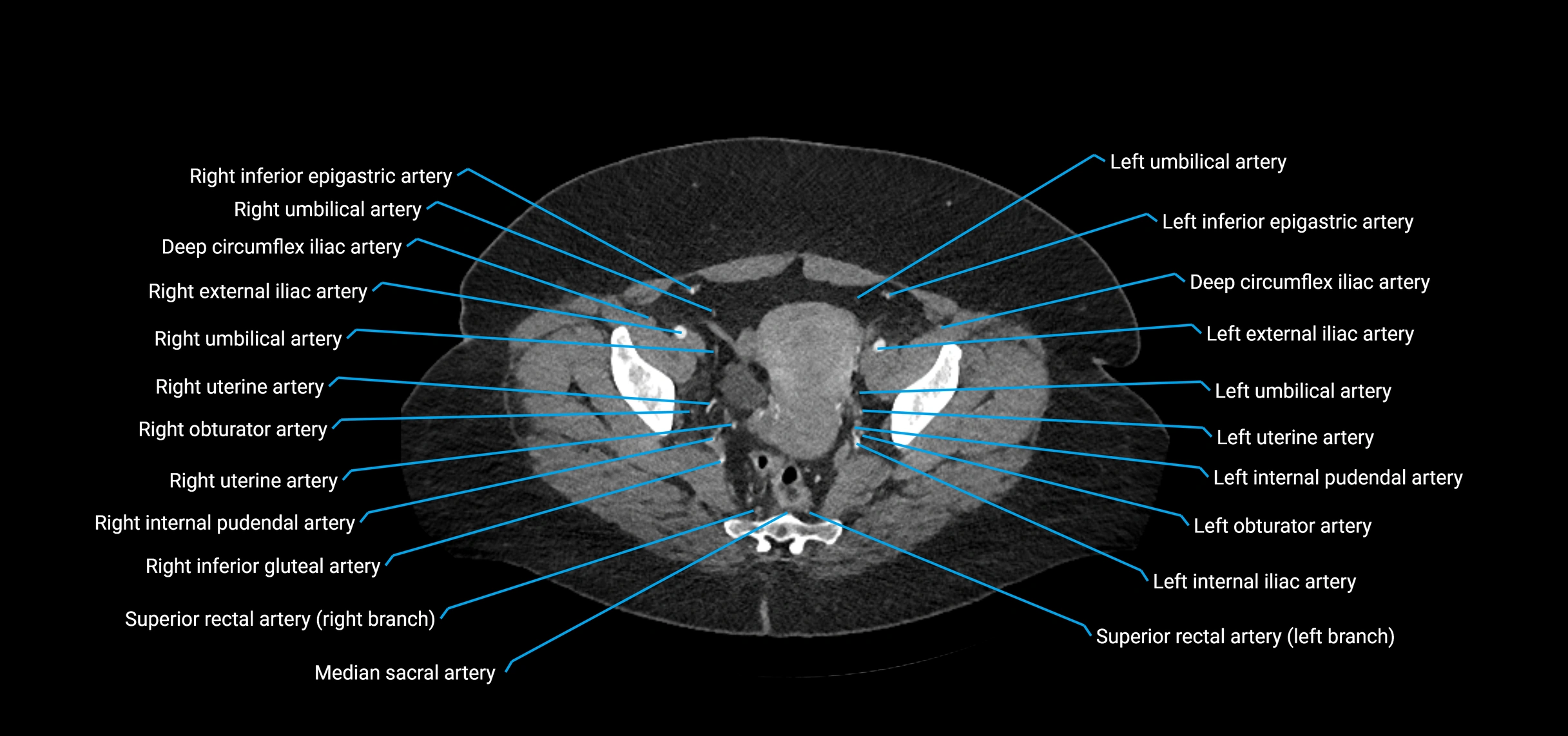 CTA abdomen axial cross sectional anatomy labelled image_220 (2).webp
